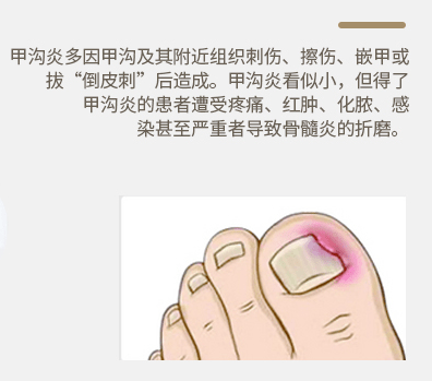 你的这些生活习惯,可能会导致甲沟炎_手机搜狐网