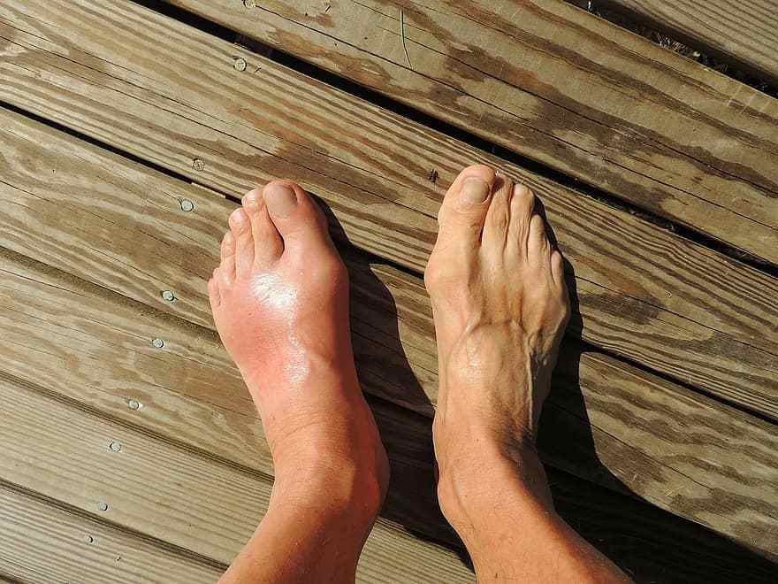 5个身体部位出现疼痛,可能是尿酸高的症状,赶紧自查下