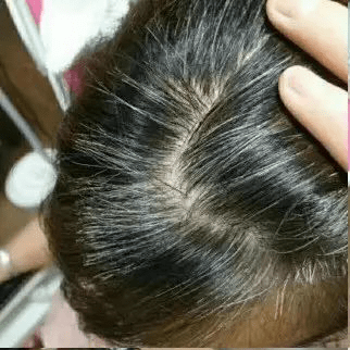 白发转黑案例分享 | 46岁治白发不算晚,刘小姐42天成功白发转黑