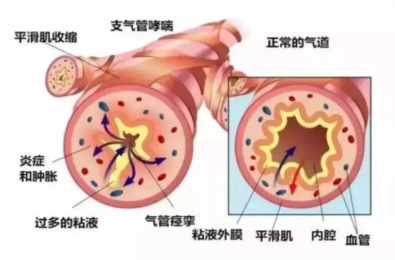 阿尔茨海默病帕金森_布病的症状及治疗方法布病传染人_阿尔茨海默病和帕金森