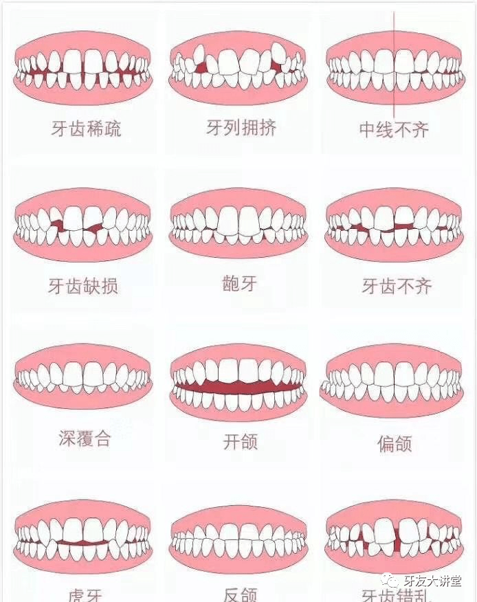 矫正牙齿今年是最适合的一年!因为带着口罩就能悄无声息就变美了!