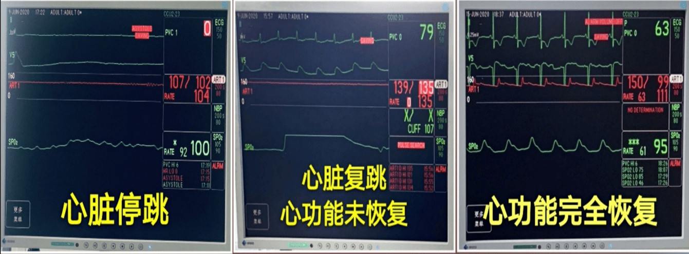 23岁女孩心脏停跳3天,72小时ecmo生死抢救