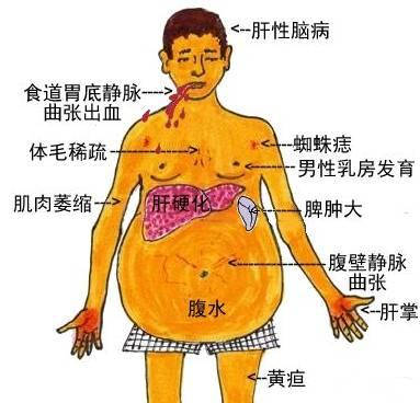 肝硬化腹水是什麼原因?還能活多久?是什麼原因導致了腹水?