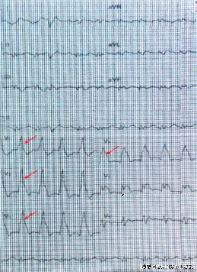 心脏性猝死的心电图预警
