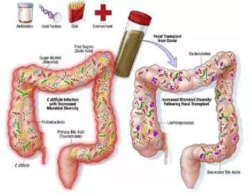 肠道|慢性便秘治疗的新技术——粪菌移植