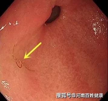 胃镜中的一幕真吓人!竟是干活时被虫虫"附身"