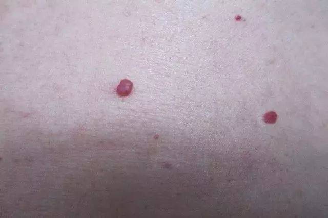 肝癌早期的红痣图片图片