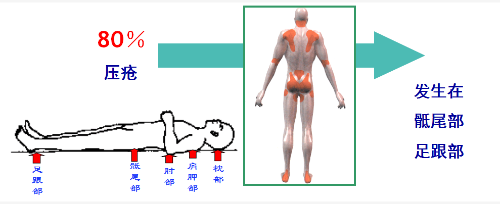 高风险压疮人群主要好发部位在骶尾部和足跟部,通过好发部位在临床