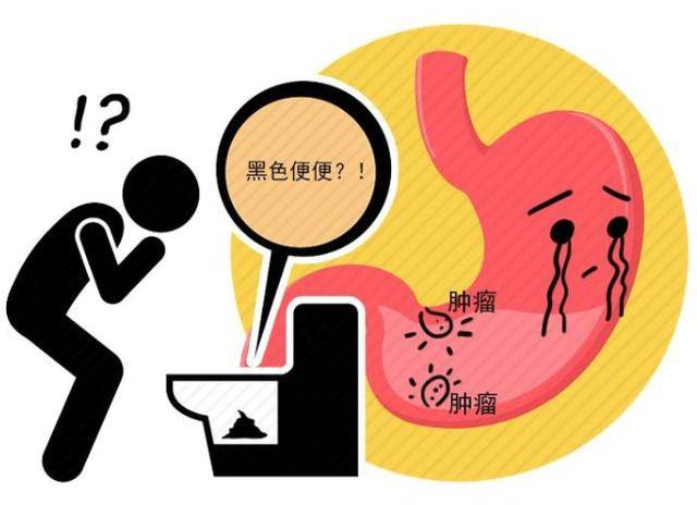 "宿便"欺骗了多少人?真正需要警惕的,是这3种异常大便