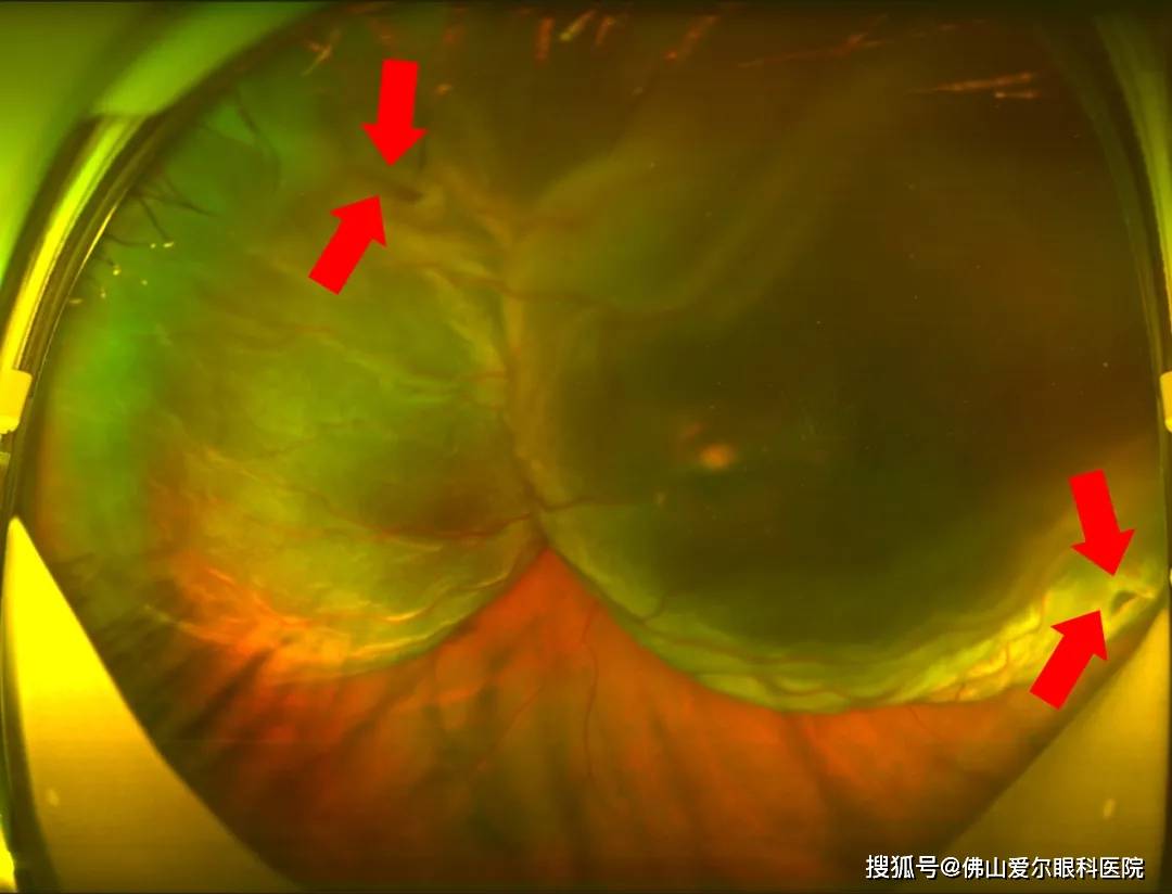 经过专业的检查后,发现其眼部视网膜有4分之3的区域都已脱离,还出现了