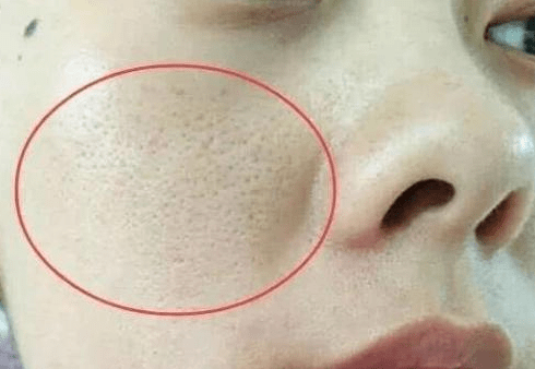 头皮上总"长痘痘",抠破还很疼,暴露出三"问题",一定要关注