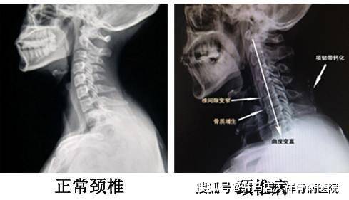 有骨刺就是颈椎病吗40岁以上女性90存在颈椎椎体的骨刺