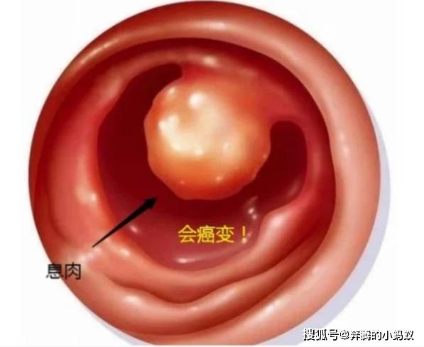 发现息肉,是不是就要切除?