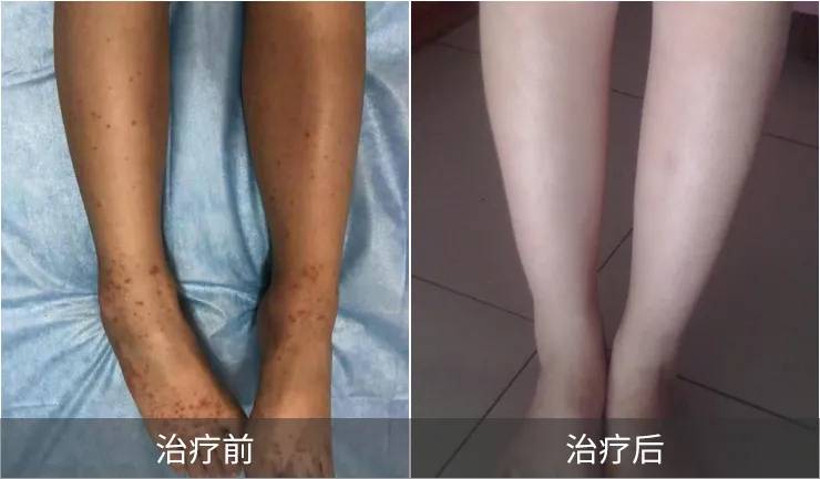 为什么提倡过敏性紫癜及早治疗!