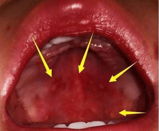 疱疹性咽峡炎中期图片图片