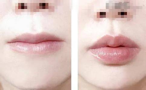 双眼皮|顾客要整成明星？参考这个照着做就行了