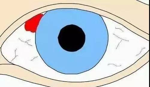 检查|为什么眼底会出血？