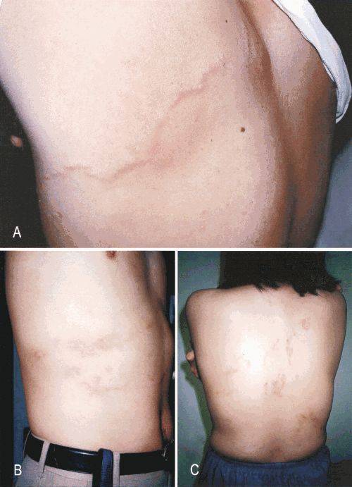 但其实颚口线虫对药物的抵抗力并不强,常见的寄生虫药就能起到很好的