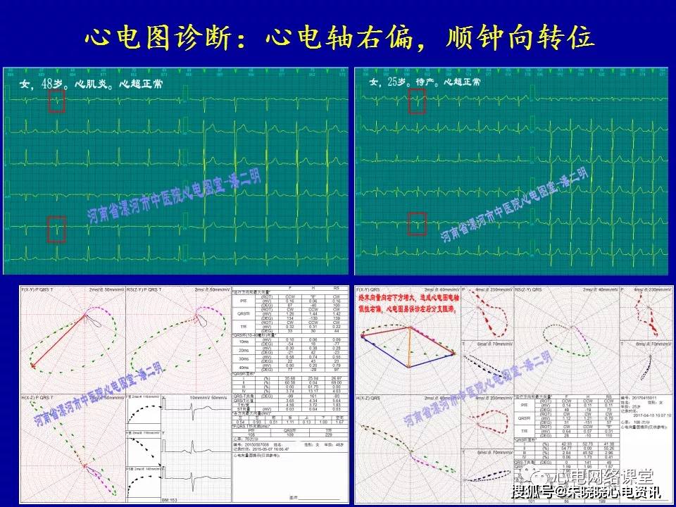 心电轴偏移在心电图和向量图上的对比分析