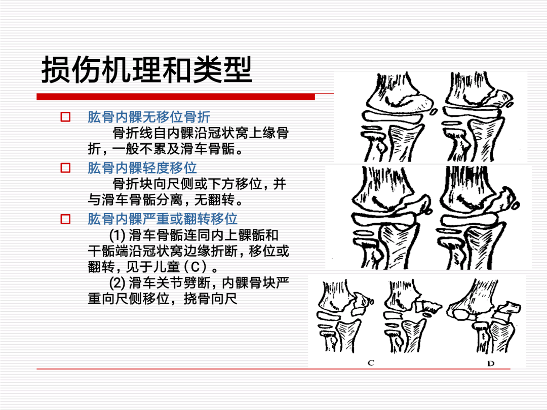 一文掌握肱骨远端骨折