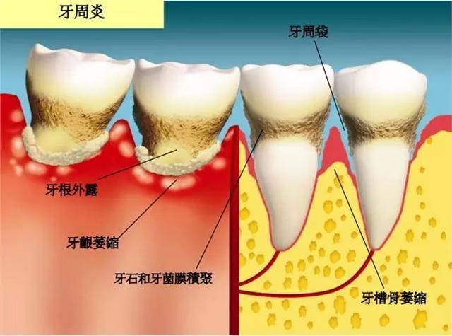 牙齿变长牙根暴露可能是这些问题惹的祸