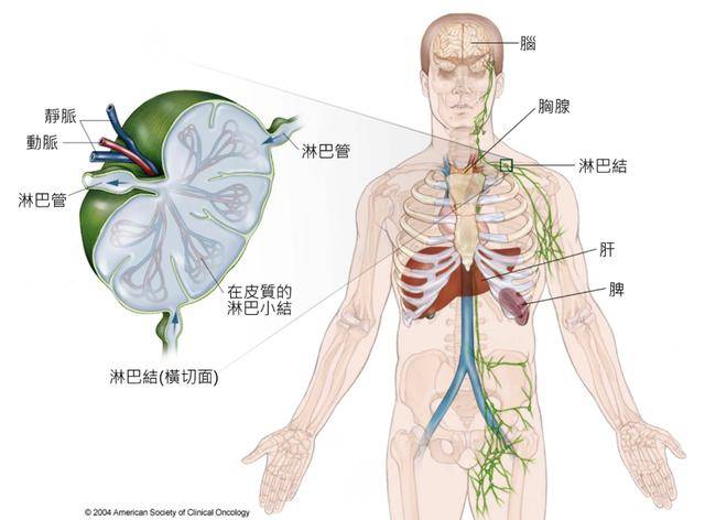 皮肤瘙痒没在意,一个月后被确诊淋巴瘤,关于淋巴瘤3点需牢记
