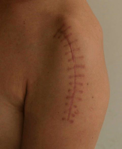 胡医生|【杭州城东医院丨案例】“新技术”为“肱骨近端粉碎骨折”患者复原