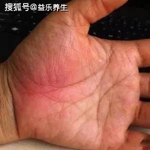 3,大鱼际色赤为热大鱼际紫青,则为瘀血阻滞的表现,若同时伴有青筋暴露