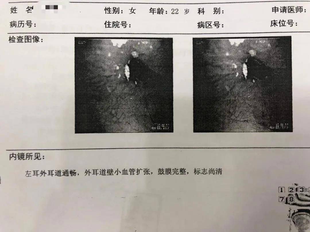 花都惠耳助聽器:癔病性耳聾:主,客觀檢查結果不一致,真不是故意為之!