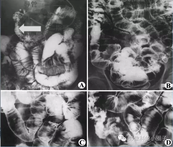 小肠影像解剖及分组
