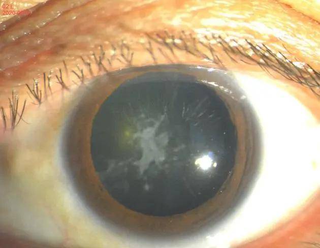 发现c先生患了明显的白内障,瞳孔区的晶状体前囊膜呈灰白色钙化灶,已