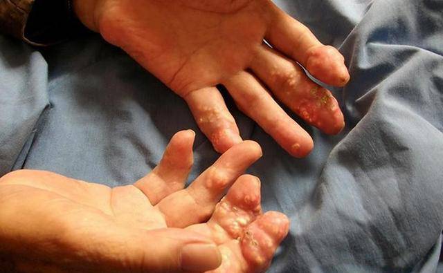 高尿酸的死对头就在身边经常吃一点排出尿酸痛风更远