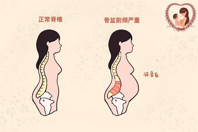 孕妇身体重心渐渐挪向前,骨盆也会向前倾,使腰椎前凸,导致慢性腰肌