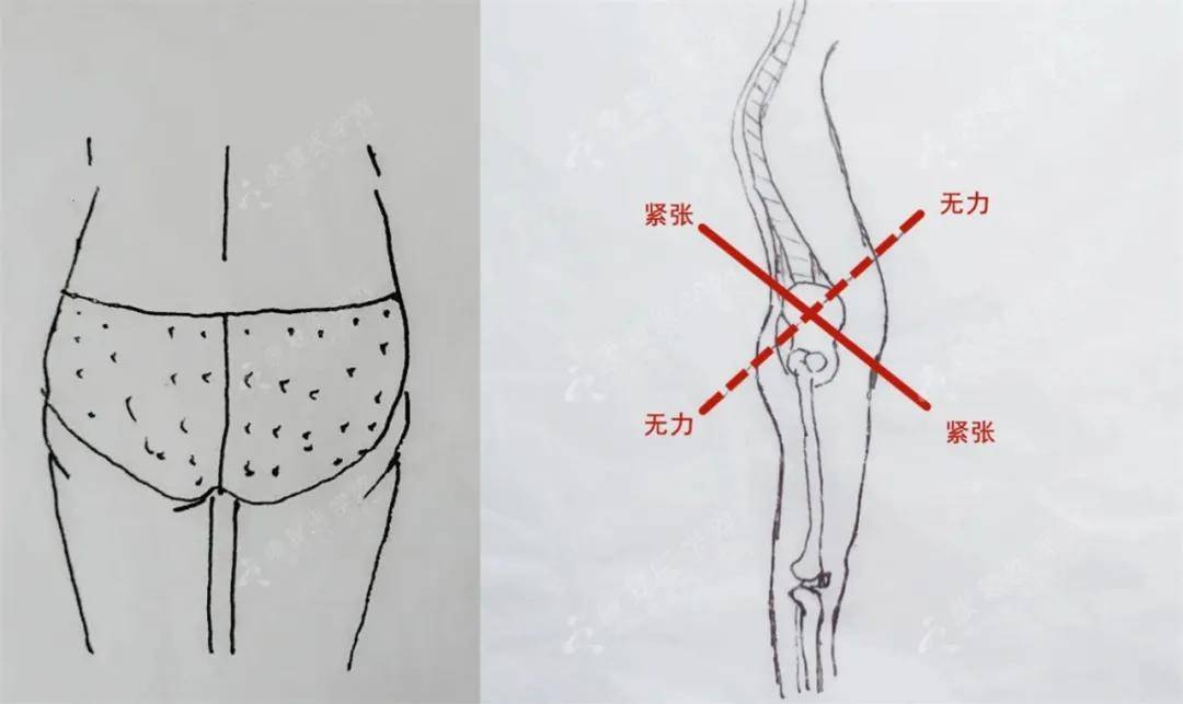 臀部塌陷肌肉代償還引發腰腿痛加強臀肌力量只需9步