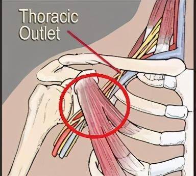 手臂痠痛麻?可能是胸廓出口綜合徵