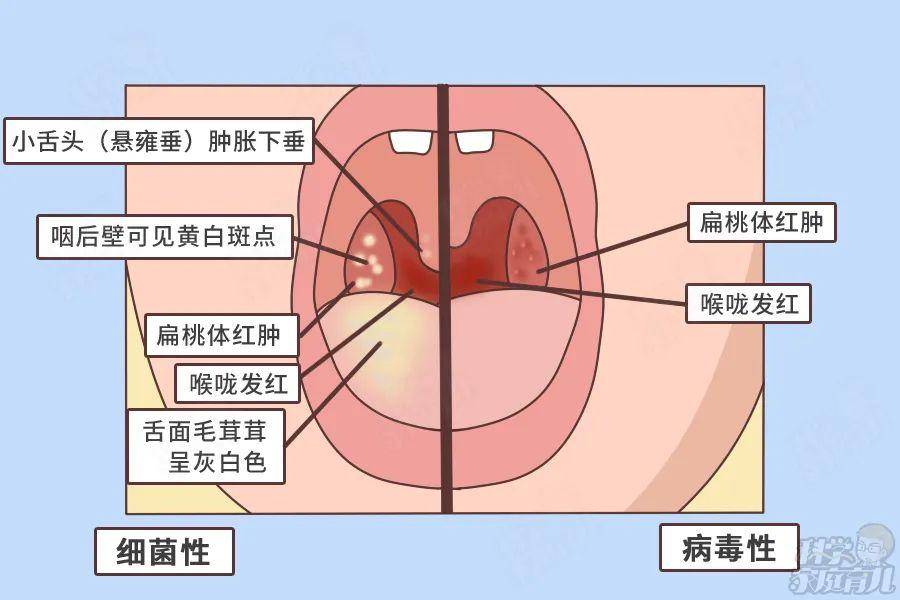 正常人的喉咙图片图片
