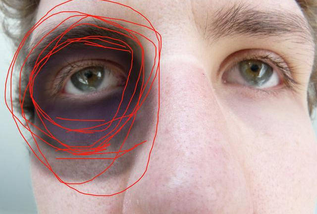 这个穴位我们就不讲针刺了,这是要专业的针灸医师来扎,不然怕刺伤眼球