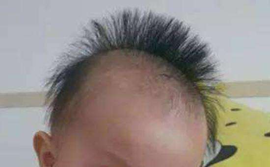 这是一种正常现象,宝宝的头发末端呈黄色,并且会逐步脱落
