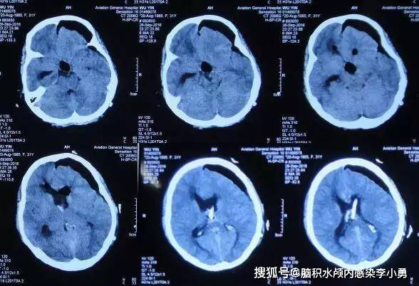 三腦室囊性顱咽管瘤繼發腦積水至今完全正常人的生活還順利生子