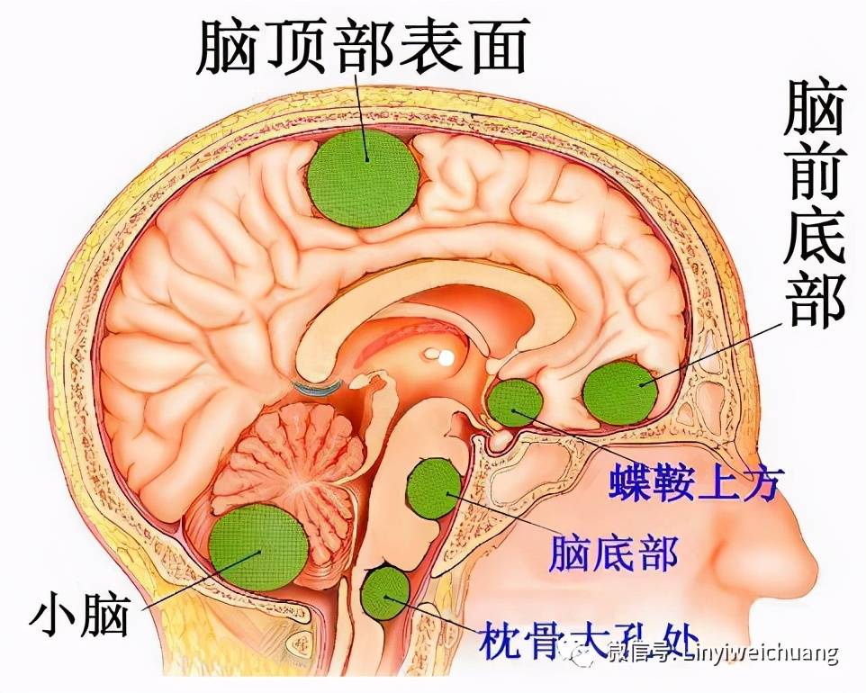 行头颅核磁共振检查了,明确肿瘤与脑组织间关系,肿瘤与矢状窦之间关系