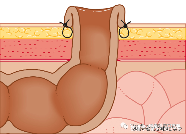 手术后,造口缝线到底要不要拆?_手机搜狐网