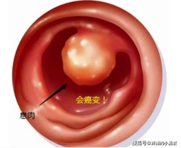 b超可以发现子宫内膜息肉吗不手术能消掉它吗