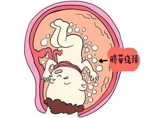 原创宝宝脐带绕颈怎么办4个方法学起来有效降低宝宝脐带绕颈风险