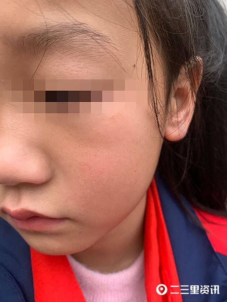 接孩子放学发现孩子脸蛋红红,耳垂发紫,情绪低落,旬阳县神河中心小学