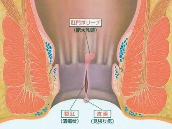 局部|肛裂出血怎么办？怎么治疗好？