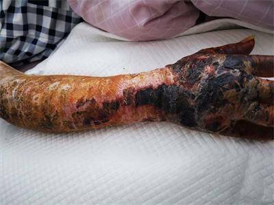 宁夏第四人民医院消化内科成功救治1例罕见重症皮肤炭疽