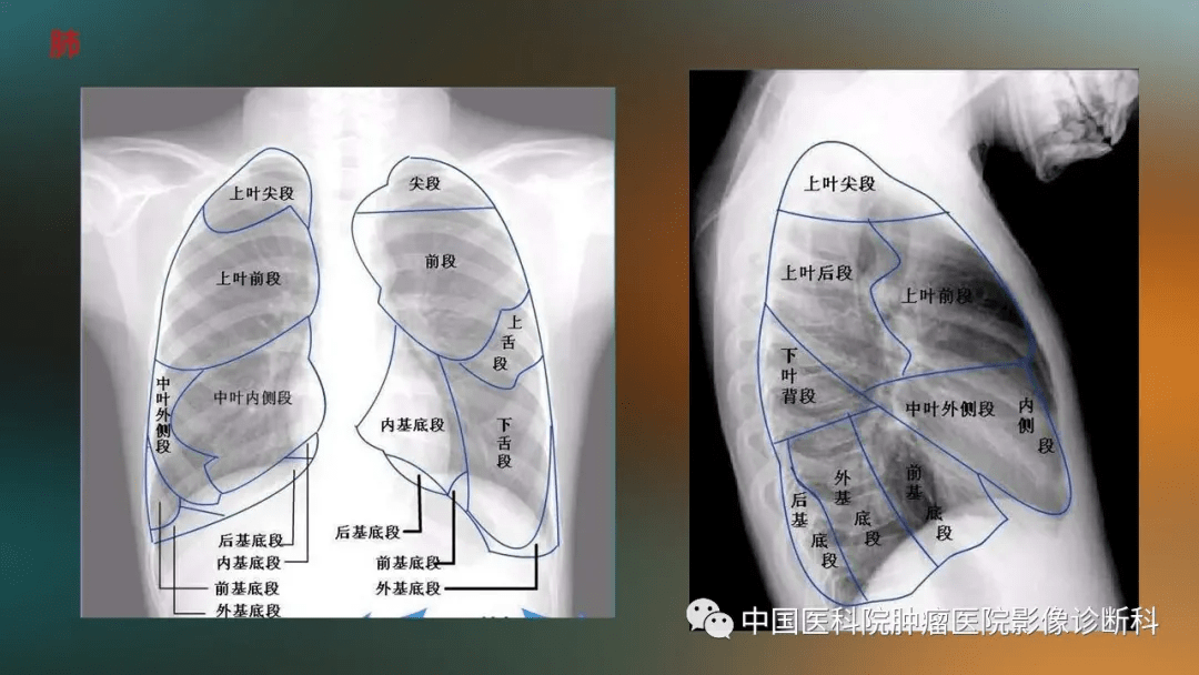 基於胸片的胸部正常解剖及變異