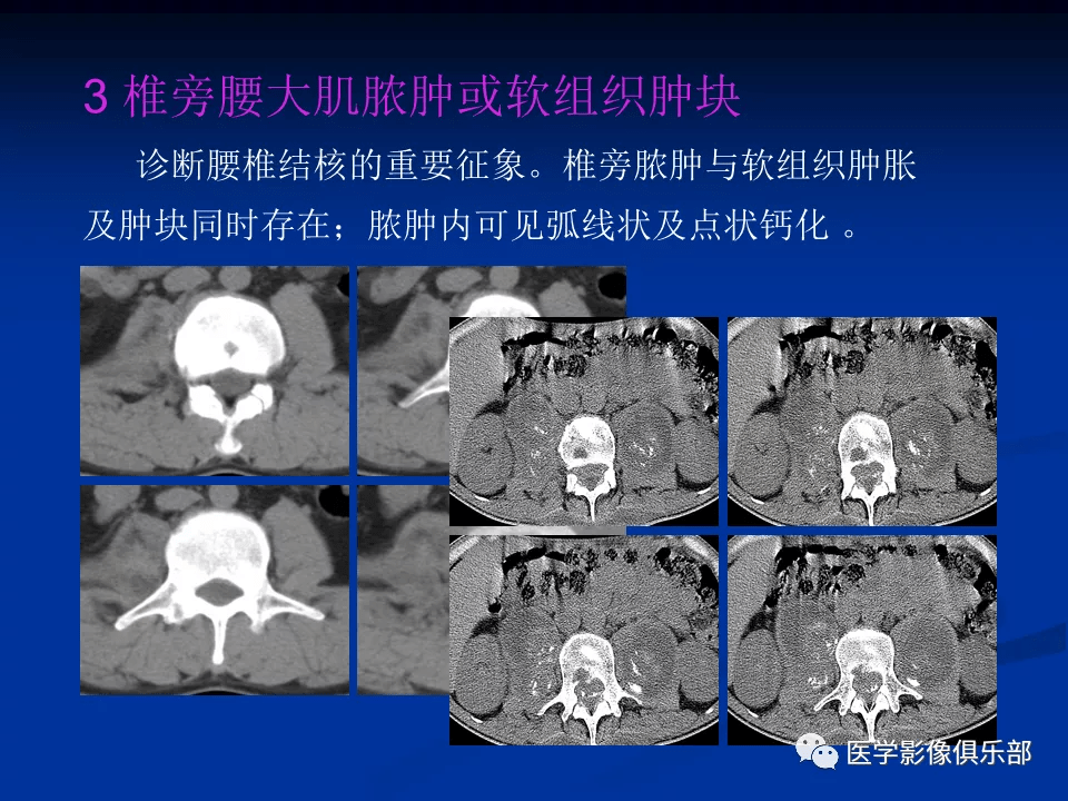 腰椎结核的ct诊断与鉴别