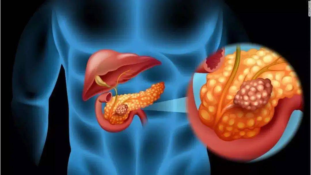 病理学术语高分化的胰腺癌究竟代表着什么