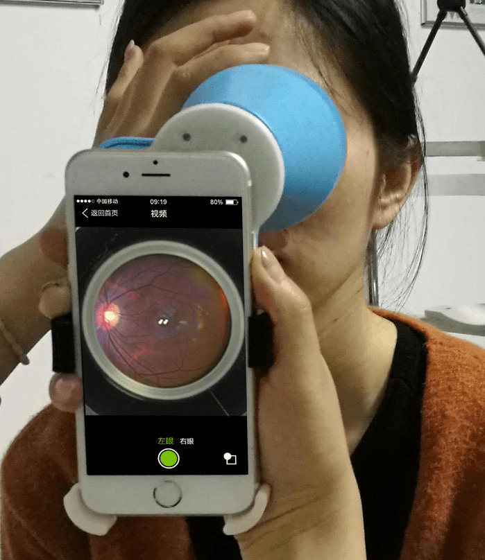 手持间接检眼镜如何拍出高品质的眼底图像